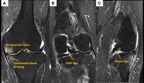 Arthroscopic Direct Meniscal Extrusion Reduction Surgical Tips To