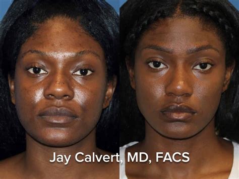 21 Non Surgical Nose Job Before After African American Ideas