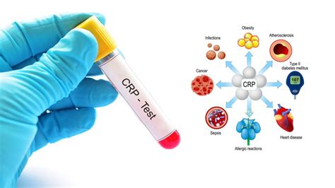 Crp Y Ksekli I Nedir B Y K Anadolu Hastanesi