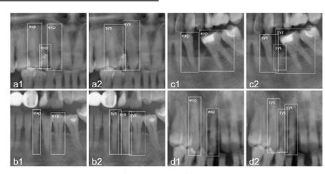 Figure 4 From Tooth Detection And Numbering In Panoramic Radiographs Using Convolutional Neural