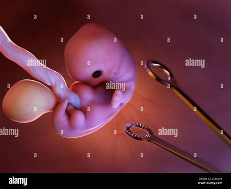 Aborto Ilustracion Fotografías E Imágenes De Alta Resolución Alamy