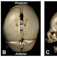 (PDF) Genetics of Crouzon Syndrome