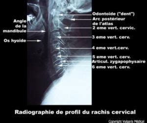 Rachis cervical radiographie de profil avec légendes Anatomie