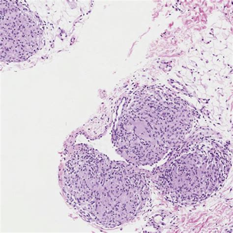 Clinical Presentation Of Cutaneous Sarcoidosis Shows Livedo