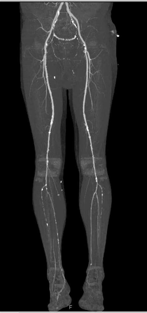 Cta Runoff With Peripheral Vascular Disease Pvd Vascular Case