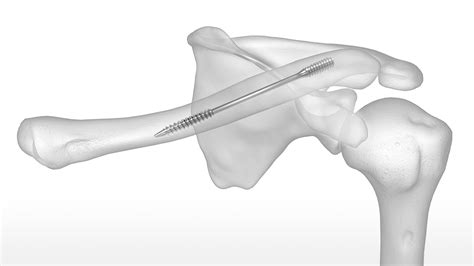 Dual-Trak Clavicle Screw System | Acumed