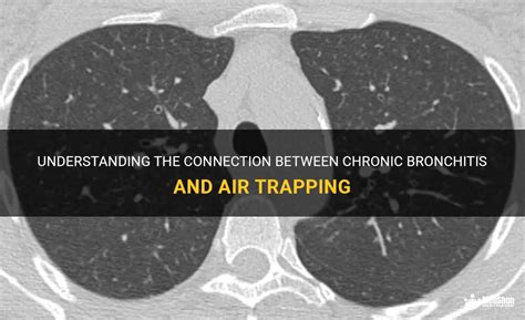 Understanding The Connection Between Chronic Bronchitis And Air