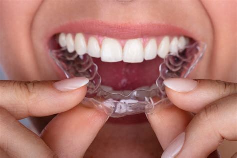 Comment Bien Entretenir Ses Aligneurs Dentiste Nice Implants