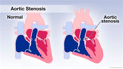 aortic valve stenosis