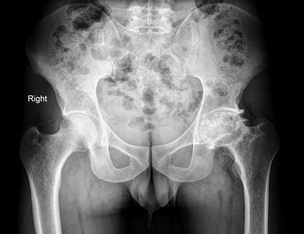 Avascular Necrosis Of The Hip Joint Radiology Case Radiopaedia Org