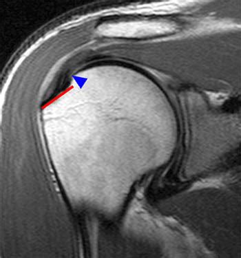 Supraspinatus Tear Mri