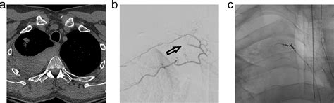 Image Guided Percutaneous Lung Needle Biopsy How We Do It Techniques In Vascular