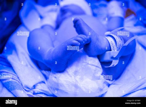 Jaundice Swollen Feet At Guillermo Brianna Blog