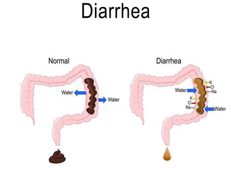 Diarrhea: Causes, Symptoms and Treatment