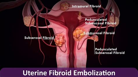 Uterine Fibroid Embolization Ufe Youtube