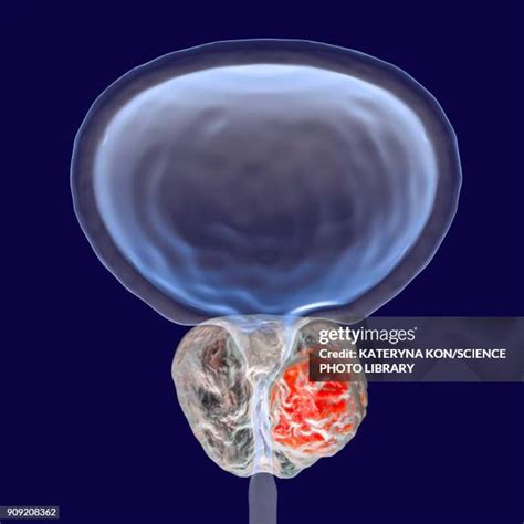 104 Prostate Cancer Anatomy Stock Photos, High-Res Pictures, and Images ...