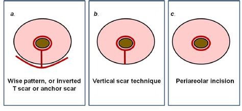 Reduction mammoplasty. What radiologists should know. | Semantic Scholar