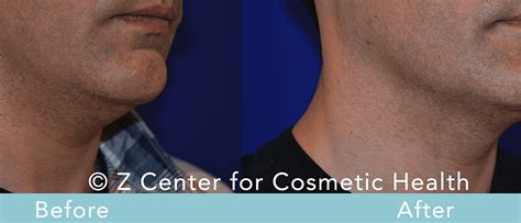 Coolsculpting Double Chin Before And After 4 Zcosmetic Health