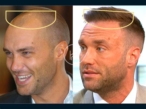 Calum Best Hair Transplant Hair Loss Technical Analysis