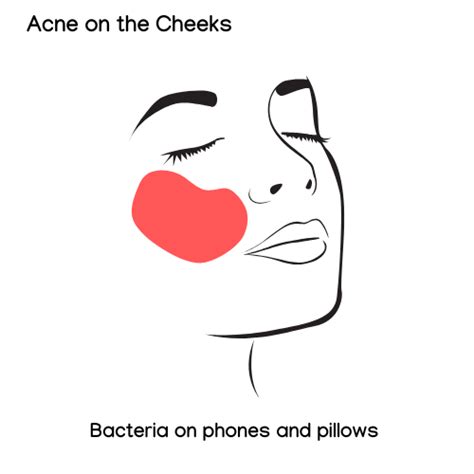 Acne Face Map - Flawless Aesthetic Clinic