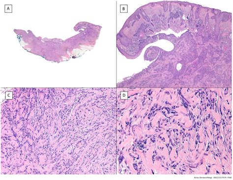 Morpheaform Basal Cell Carcinoma Histology