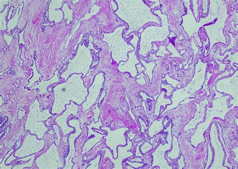serous cystadenoma stock photo  image  anatomy
