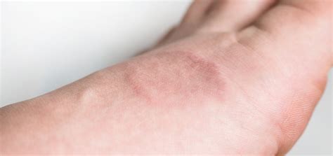 Granuloma Annulare Dermatology And Skin Health Dr Mendese