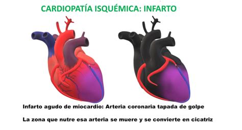 ️ Infarto De Miocardio Guía Sencilla Realizada Por Cardiólogos