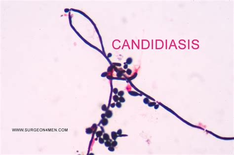 Кандида Грамм – Telegraph