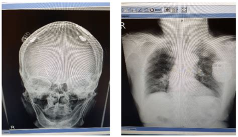 X Ray Showing The Placement Of Deep Brain Stimulation Electrodes And Download Scientific