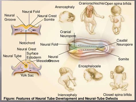 Neural Tube Defects Ntds In Infants