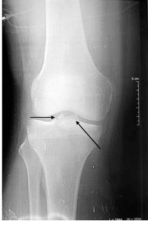 Figure 3 from Tibial intercondylar eminence fractures in adults ...