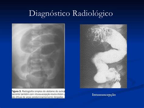 Exame Limitado Parcialmente Por Distensão Gasosa Intestinal - Aspectos Clínicos e Radiológicos da Obstrução Intestinal
