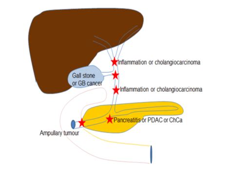 19 GI Liver Pathology Flashcards Quizlet