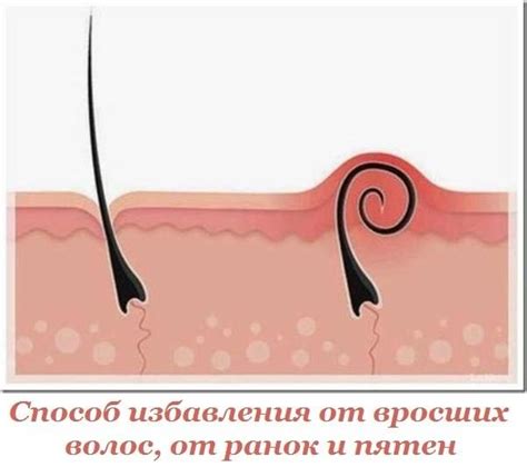 Способ избавления от вросших волос, от ранок и пятен, которые остаются ...