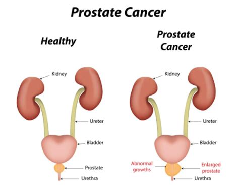 Prostate Cancer Dubai Healthcare City Westminster Ortho Med Clinic