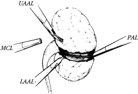 Figure 1 From Laparoscopic Wedge Resection And Partial Nephrectomy