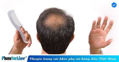 Lý giải chuyện nam giới hói đầu do ham sex Phụ Nữ Sức Khỏe