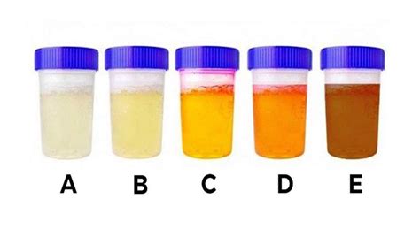 Kolor moczu sprawdź o czym mówi