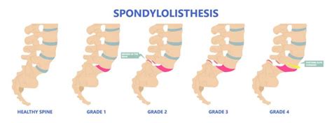 Retrolisthesis: Definition - Spine Info