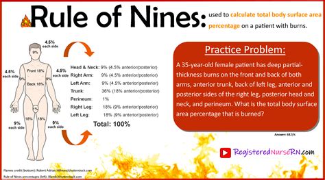 The Rule Of 9s Estimating Burn Surface Area 53 Off