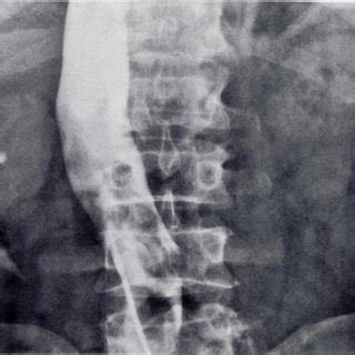 (PDF) The abnormal nephrogram