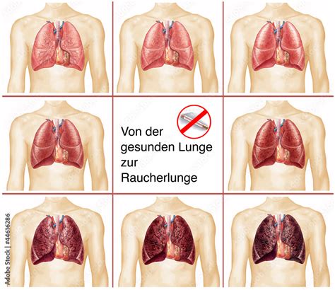 Gesunde Lunge Raucherlunge Brustkorb Lungenfl Gel Stock Illustration