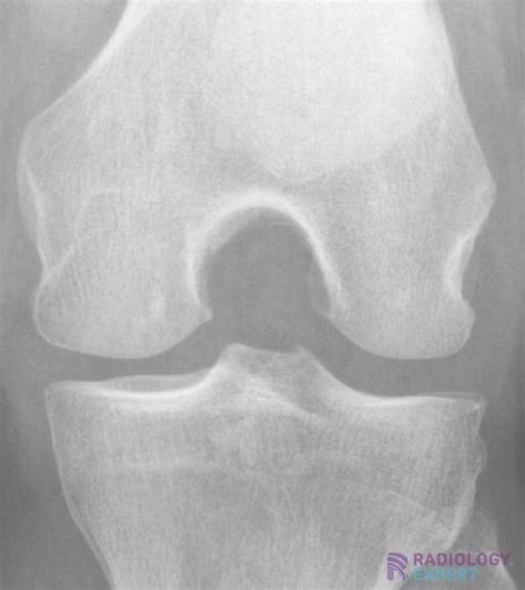 X Knee