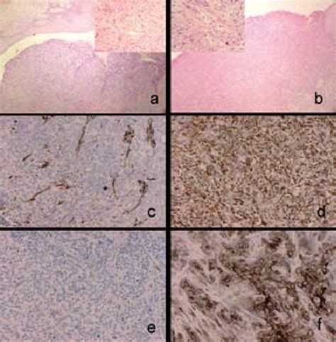 Basal Cell A And Poorly Differentiated Sarcomatoid Squamous Cell