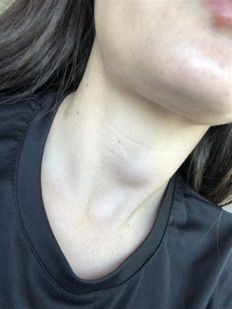 24yo female noticed this lump In My throat about two weeks ago my mom