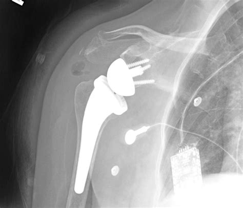 Shoulder And Elbow Surgery Reverse Total Shoulder Arthroplasty For