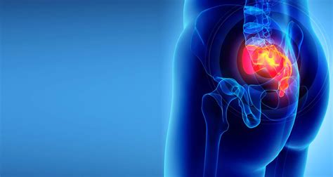 Cisto Pilonidal Dr Lucas Sobrado