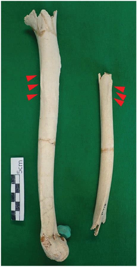 arrows   deltoid tubercles   bilateral humerus