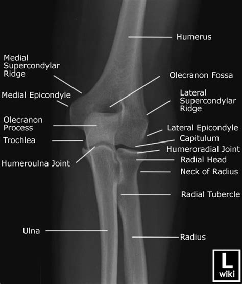 Elbow Radiographic Anatomy Wikiradiography Diagnostic Imaging